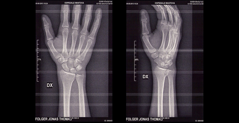 jonas folger lesion